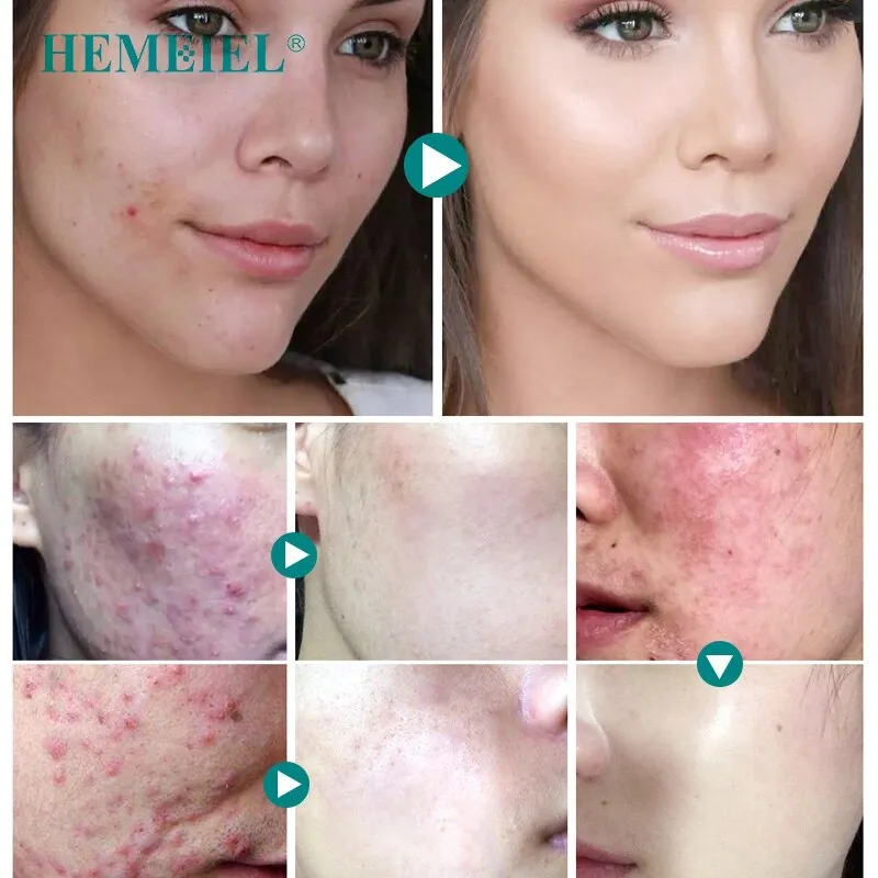 HEMEIEL Herbal Anti-Acne Cream Oily Skin Acne Stains Moisturizing Acne Treatment Face Cream Care Acne Scar Remove Blackhead