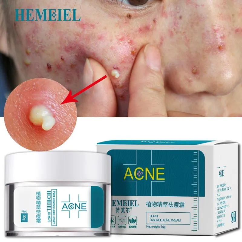 HEMEIEL Herbal Anti-Acne Cream Oily Skin Acne Stains Moisturizing Acne Treatment Face Cream Care Acne Scar Remove Blackhead